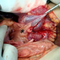 Loculated cystic lesion with watery clear fluid over retroperitoneum