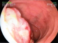 Gastro-duodenoscopy demonstrating a tumor at the ampulla of Vater