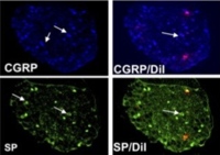 Anti-NGF treatment results in downregulation of substance P and CGRP