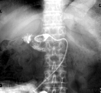 Fistulography showing the disappearance of the fluid collection around the pancreaticojejunal anastomosis