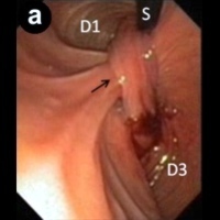 Long pedicle-like structure
