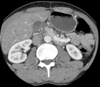 Ill-defined hypoechoic mass in the head of the pancreas at CECT