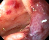 Image of the mass from upper endoscopy
