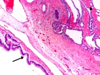 Histological slide demonstrating synchronous IPMN and serous cystadenoma