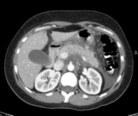 Extensive peripancreatic inflammatory changes and stranding