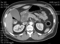 Pseudocyst in the head of the pancreas compressing the common bile duct and duodenum