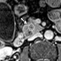 T1-weighted fast-field echo short-time inversion recovery (FFE STIR) post-contrast image shows a solid lesion with inhomogeneous late-phase enhancement