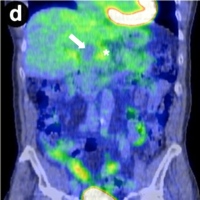 CT-PET showing no uptake within the cystic component of the mass