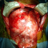 Operative photograph showing the tumor