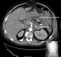 Involvement of mesocolon by pancreatic inflammatory process