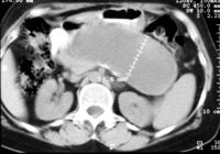 A well-circumscribed unilocular pancreatic pseudocyst