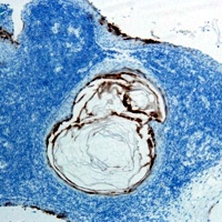 Immunoperoxidase positivity for CEA in the epithelium of the cyst