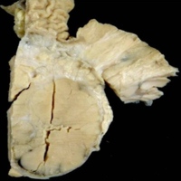 A solid mass in the head and body of the pancreas measuring 6.5x6.0 cm with a variegated cut surface