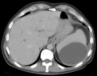 Splenic sub-capsular haematoma