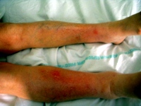 Multiple erythematous subcutaneous nodules on the lower legs