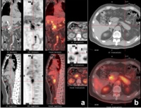 Diffuse tracer uptake by the pancreas (crosshairs)