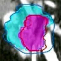 Dose painting of pancreas protocol CT scan (detail)