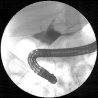 Initial ERCP showing a leaking bile duct, biliary sphincterotomy and stenting