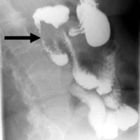 Double contrast barium radiography showing stenosis of the second duodenum