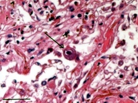 The lungs show intestinal pneumonitis