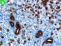 Immunohistochemical findings for CK7