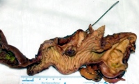 Pancreaticoduodenectomy specimen