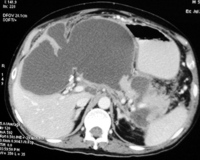 CECT abdomen showing a large intrapancreatic fluid collection extending into the hepatogastric ligament