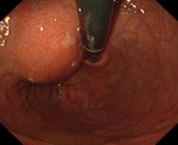 Submucosal tumor