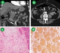 Aorto-caval lymph node