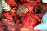 Pseudoaneurysm with a thin wall