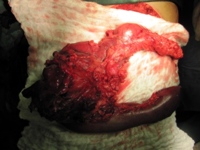 Specimen after Whipple resection revealing a large duodenal GIST tumor.