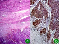 Metastatic tumor deposits in the liver parenchyma with strong CD117 expression