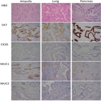 Histopathology of ampullary, lung, and pancreatic cancers