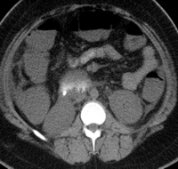 Diffuse enlargement and hypoattenuation of pancreas