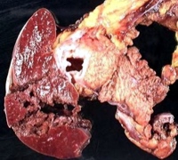 Resected mucinous cystic neoplasm