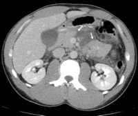 Transection at the junction of the pancreatic neck and body