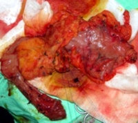 Intraoperative findings of the Whipple surgical specimen
