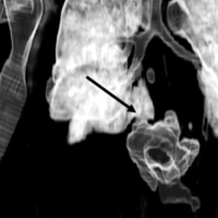 3-dimentional reconstruction of the pancreaticobronchial fistula