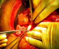 Extraction of a germinating membrane from a hydatid cyst in the pancreatic head