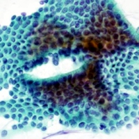 Non-atypical cells in pancreatic juice