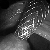 Endoscopic view of transduodenal self-expandable metallic stent