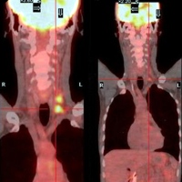 PET/CT scans before and after chemotherapy