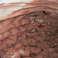Endoscopic image demonstrates non-erosive gastric inflammation