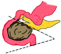 A schematic presentation of the cystic mass