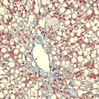 Liver biopsy showing signs of cholestasis with pericentral and pericellular fibrosis