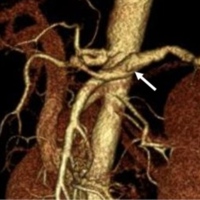 3D-CT angiography showing a leakage of contrast medium from a fusiform aneurysm of the middle-distal splenic artery