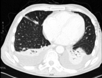 Pulmonary nodules on computerised tomography