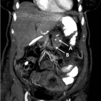 Sagittal view of the pancreaticojejunostomy