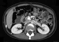 Abdominal enhanced CT in a patient with calcified chronic pancreatitis