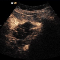 CEUS in a patient with mucinous cystadenoma